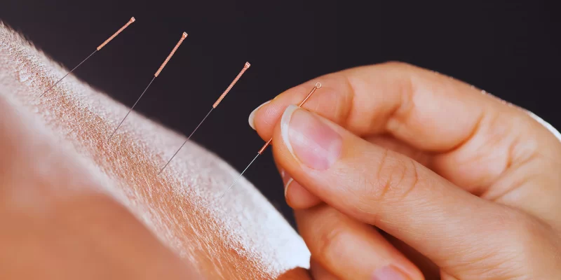 Acupuntura: Harmonia Energética